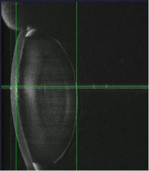 lens dislocation