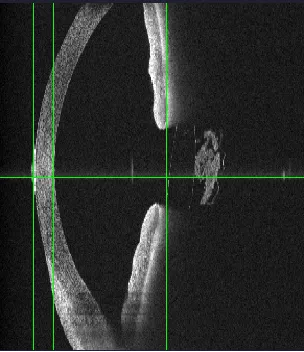 posterior capsular opacification