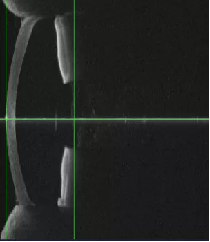 aphakic eye