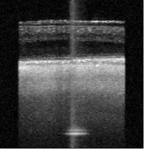 macular edema