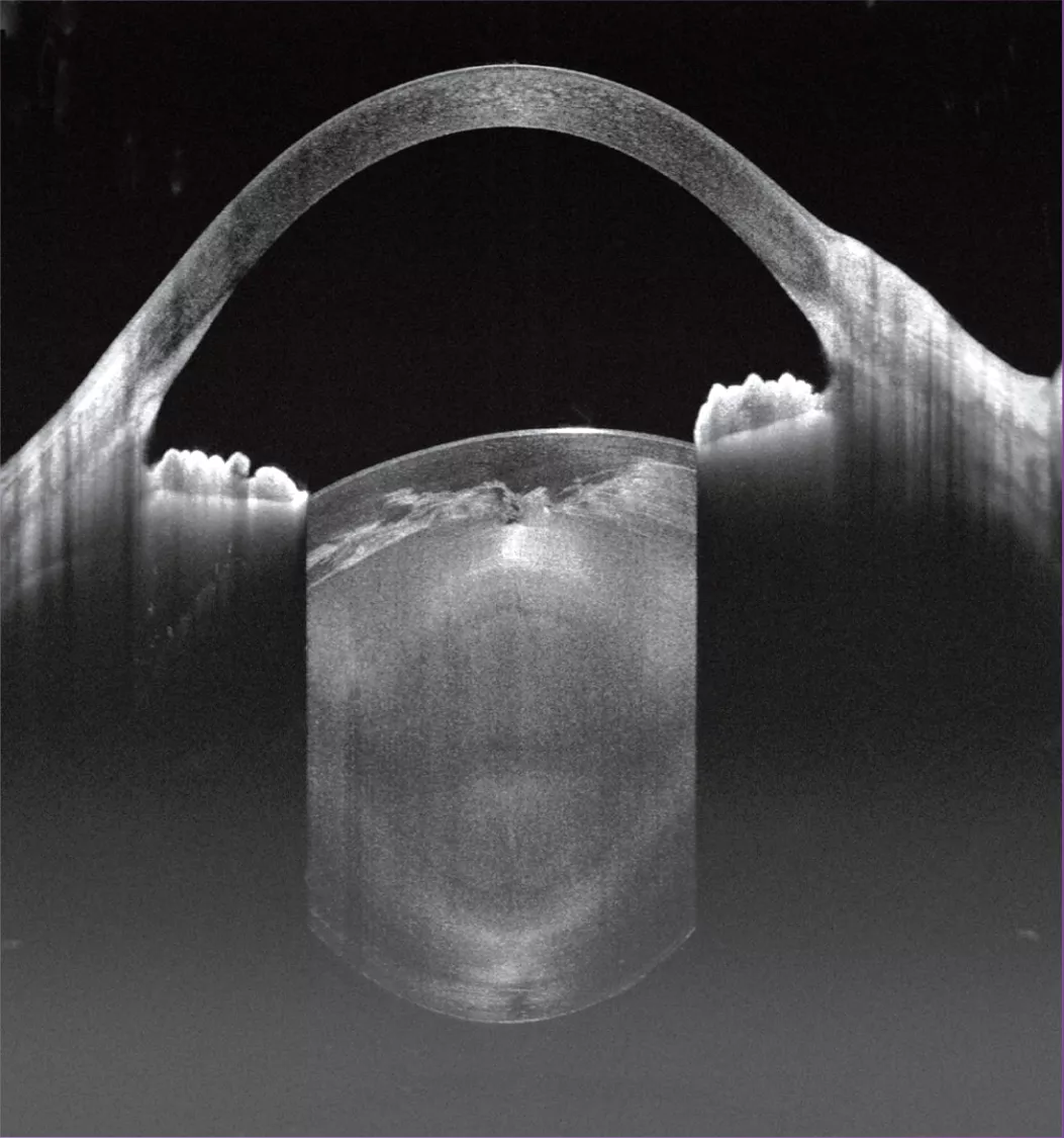 Panaromic Anterior Segment- Cataract